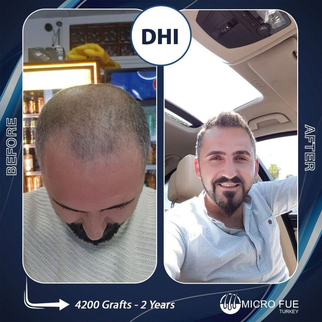 Direct Hair Implantation (DHI):