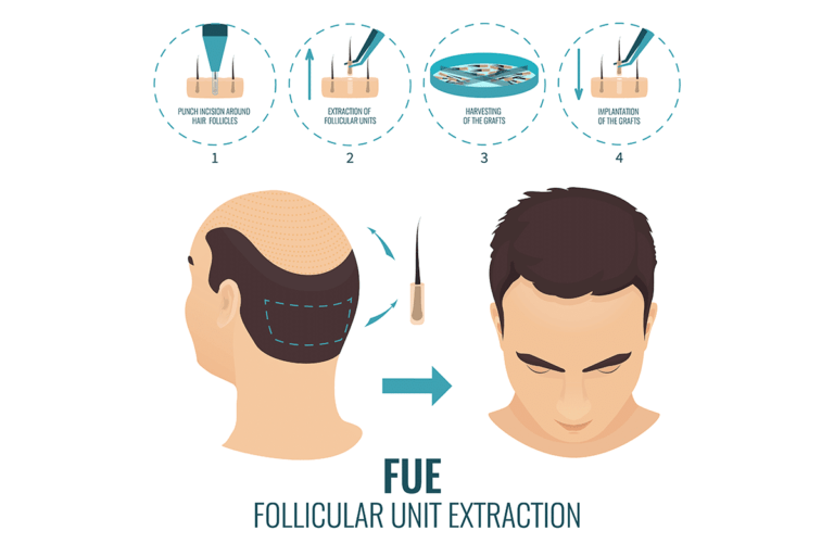 Follicular Unit Extraction (FUE)