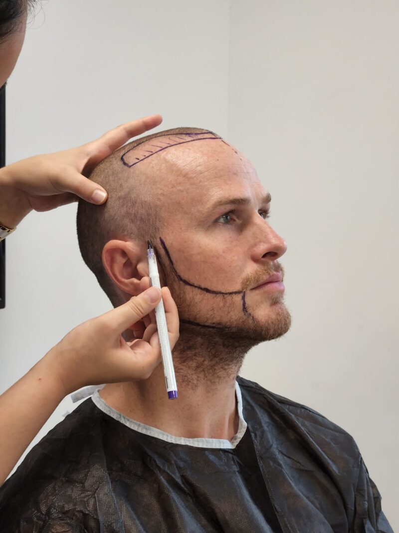 Your Step-by-Step Guide to Beard Transplants in Turkey