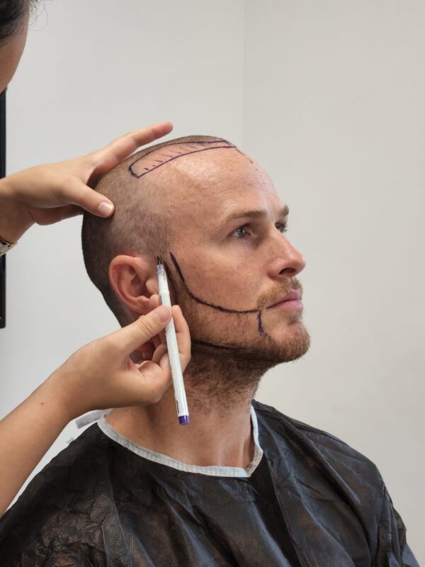 How to Book a Hair Transplant?