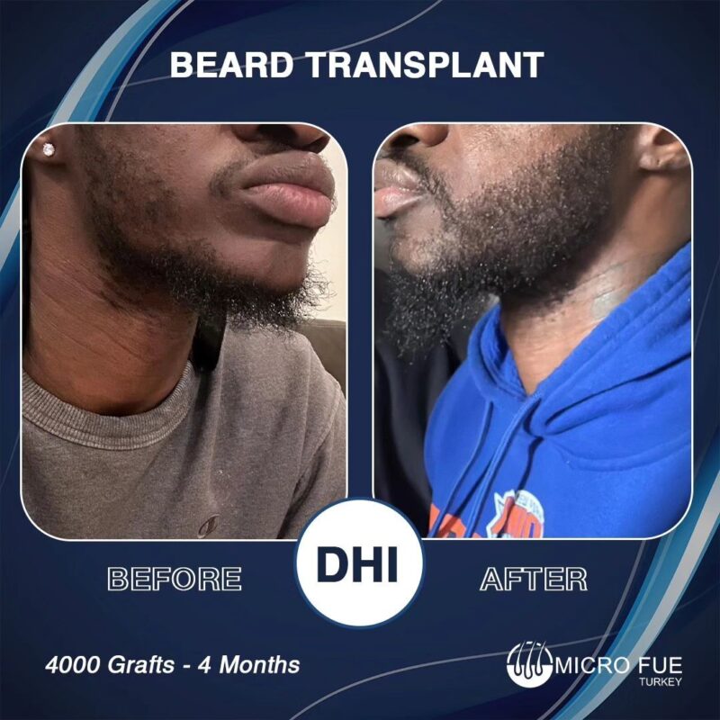 Advantages of Beard Transplant in Turkey