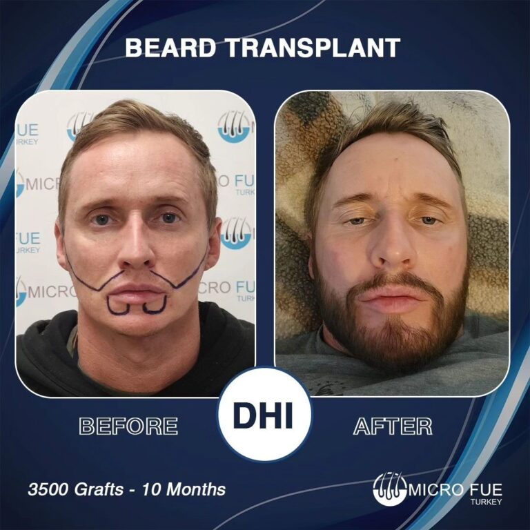 How Much Is a Full Beard Transplant in Turkey in 2025?
