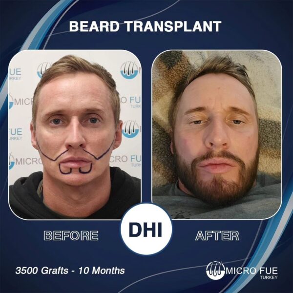 How Much Is a Full Beard Transplant in Turkey in 2025?