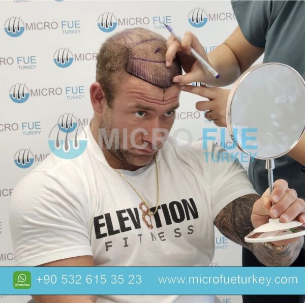 Affordable PRP Hair Treatment in Turkey