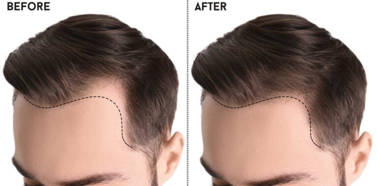 Hair Transplant in Turkey