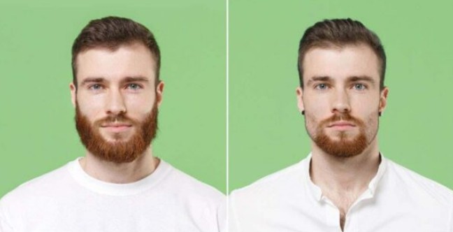 Beard Transplant in Taksim, Istanbul – Natural & Dense Results 2026