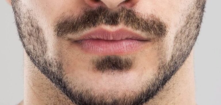 How Much Does a 2000 Grafts Beard Transplant Cost?