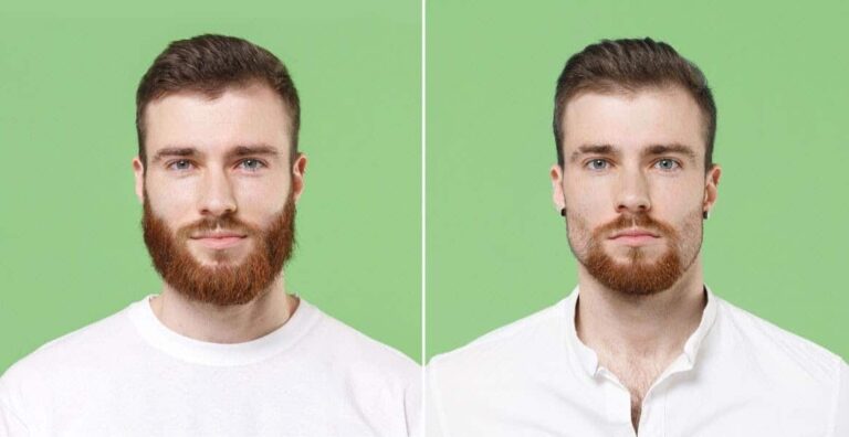 Top Benefits of Choosing Turkey for Your Beard Transplant