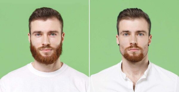 Top Benefits of Choosing Turkey for Your Beard Transplant