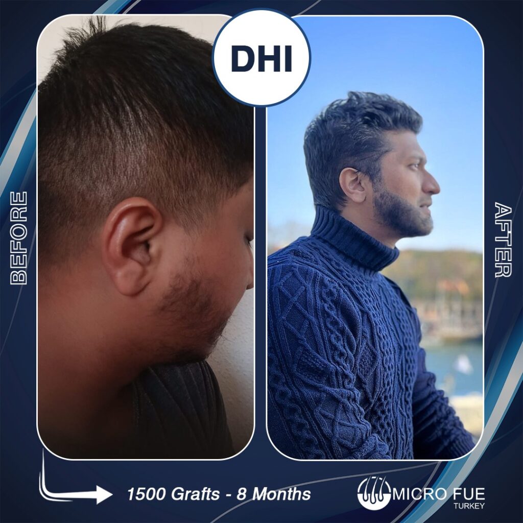 DHI Beard Transplant Turkey