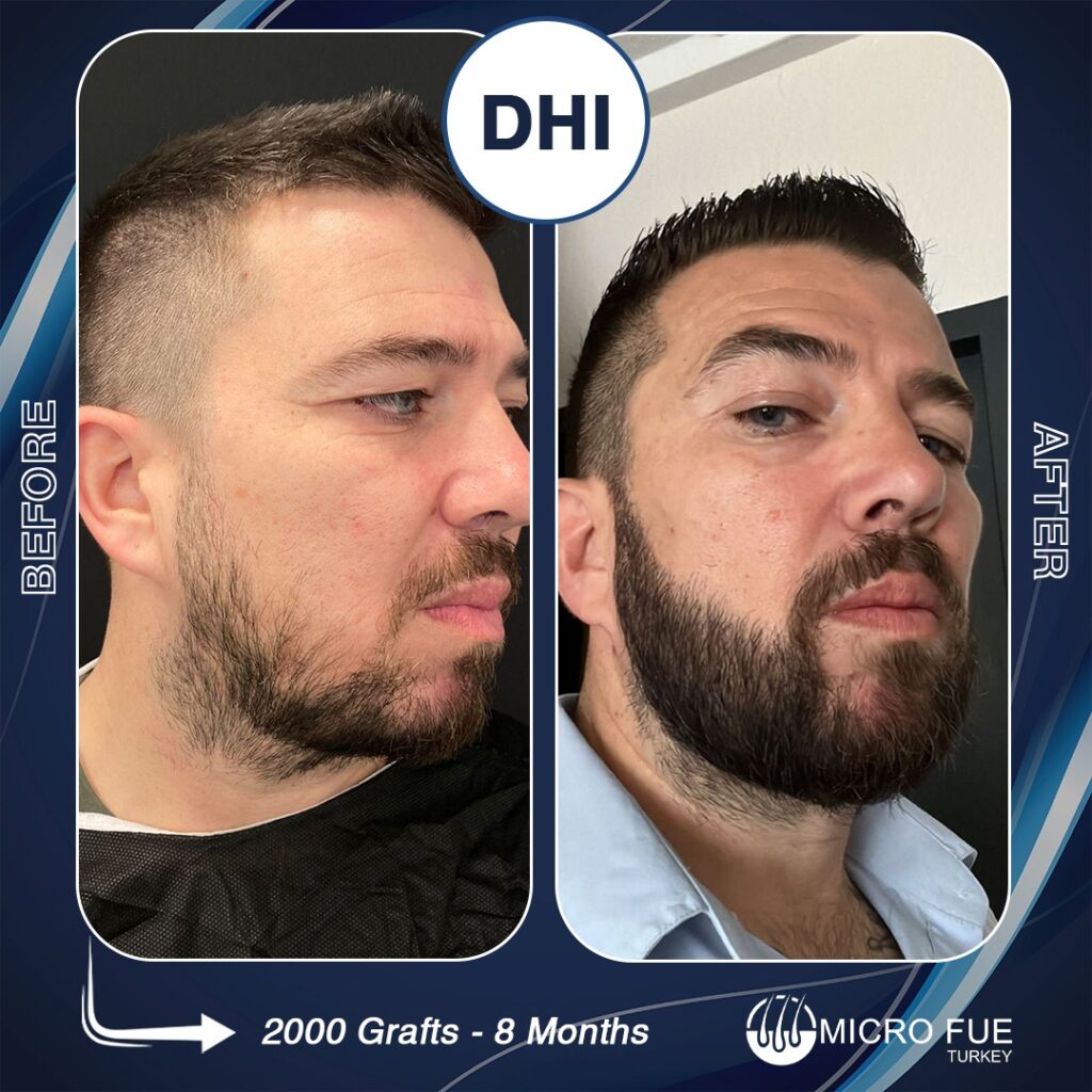 Antalya Beard Transplant
