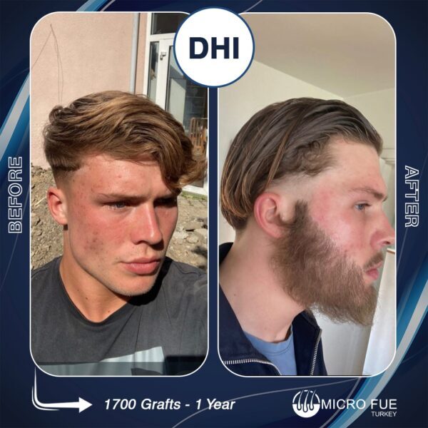 Beard Transplant Prices Turkey