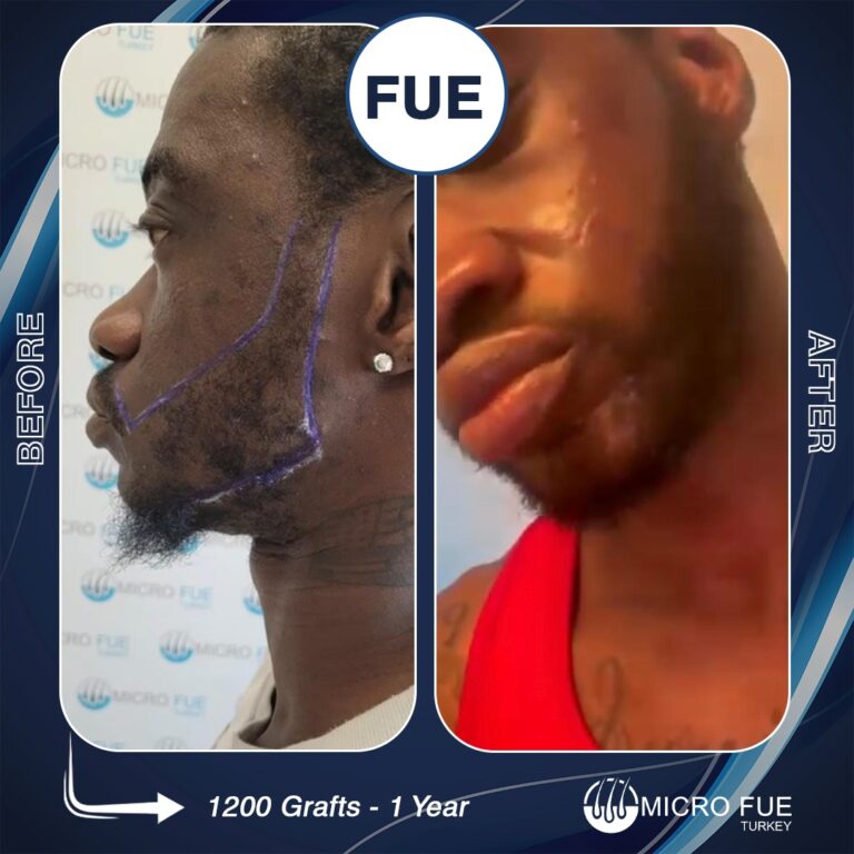FUE Beard Transplant Turkey