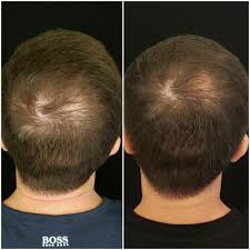 Affordable PRP Hair Treatment in Turkey