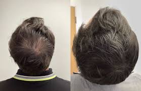 Affordable PRP Hair Treatment in Turkey